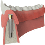 Prothèse sur implant
